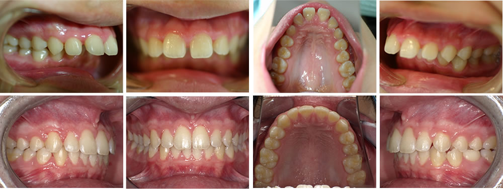 出っ歯(上顎前突)の矯正治療例の治療例