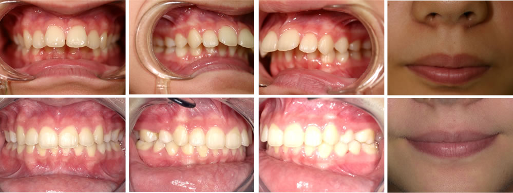 出っ歯(上顎前突)の矯正治療例（13歳女性 治療期間6年）