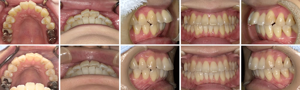 上顎前突の治療例