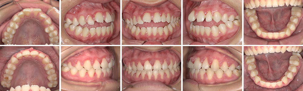 開咬(前歯が咬まない)の治療例