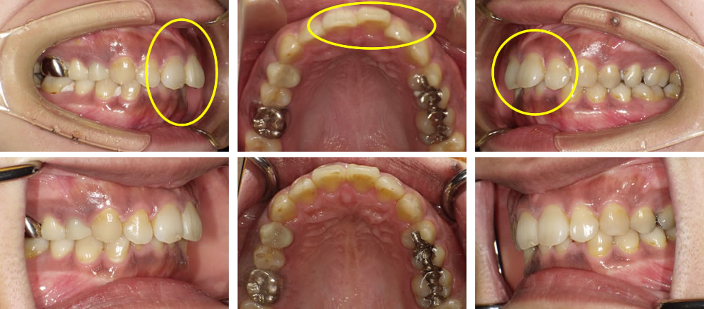 前歯の部分矯正症例