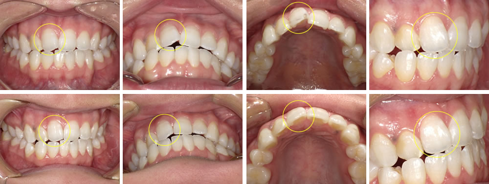 前歯の部分矯正症例