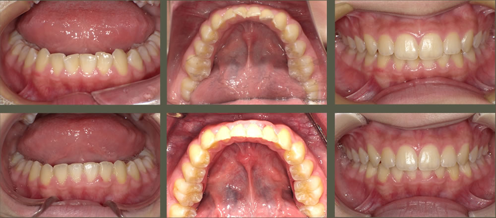 下の前歯の部分矯正症例