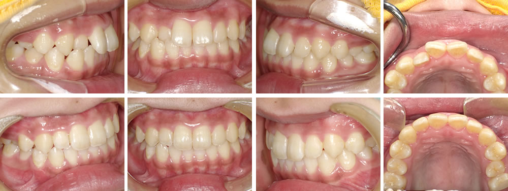 上の前歯の部分矯正症例