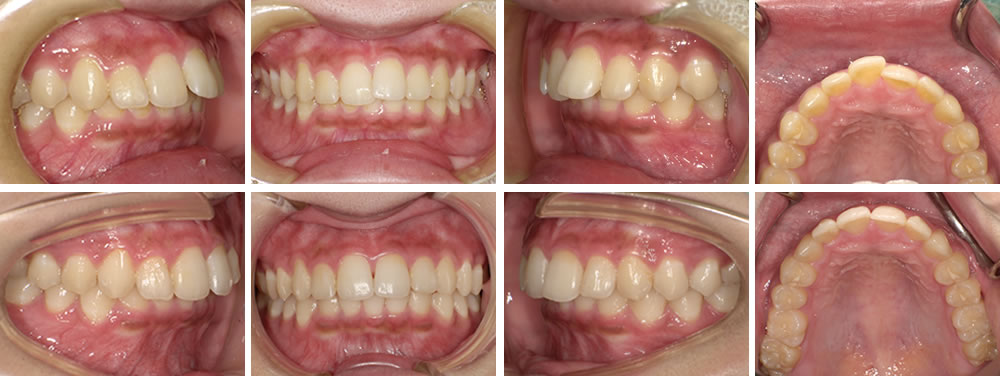 アライナーによる部分矯正治療例