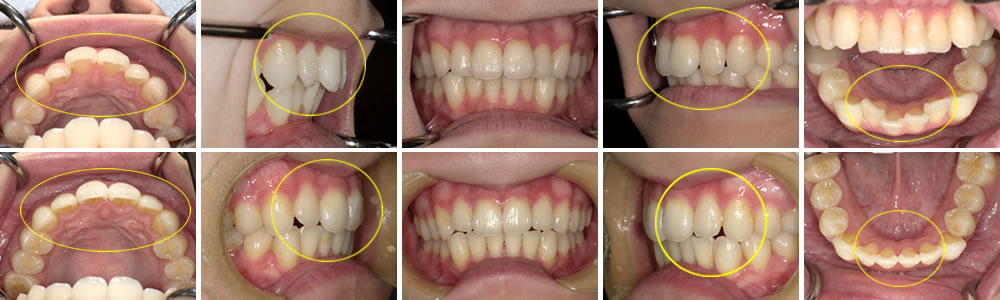 アライナーによる部分矯正治療例