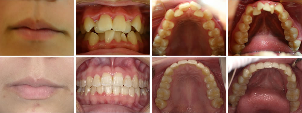 子どもの叢生・八重歯の矯正治療例（13歳女子 治療期間4年）