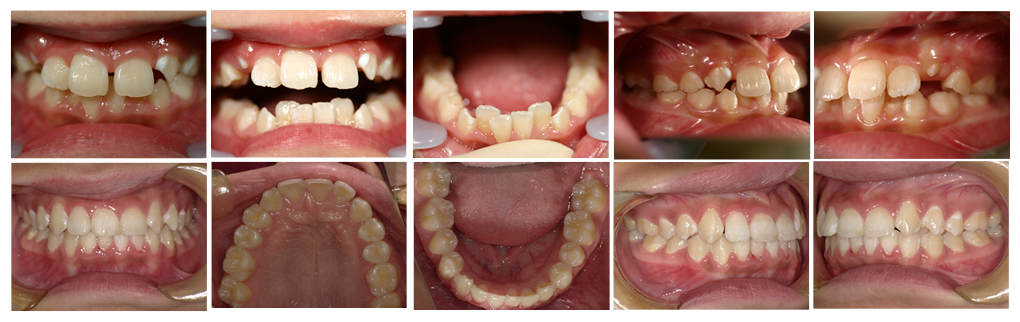 子どもの叢生・八重歯の矯正治療例の治療例