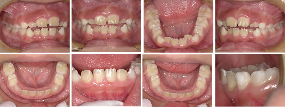 子どもの叢生・八重歯の矯正治療例の治療例