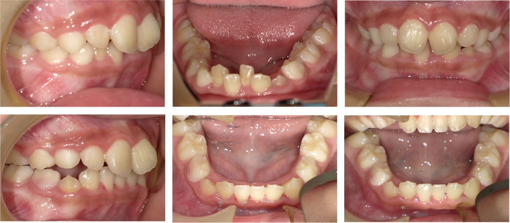 子供の叢生・八重歯の矯正治療例（9歳女子 治療期間9ヶ月）