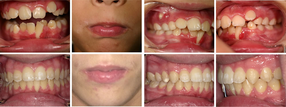 子供の叢生・八重歯の矯正治療例（10歳男子 治療期間5年）