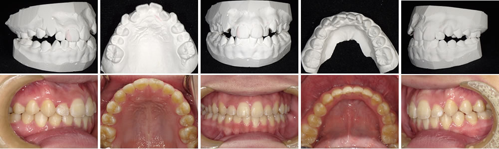 子どもの叢生・八重歯の矯正治療例