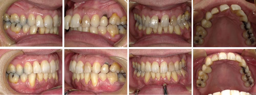 すきっ歯の矯正治療例（50代女性 治療期間7ヶ月）