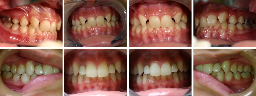 すきっ歯の治療例