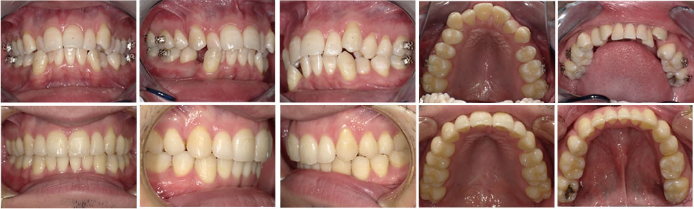 叢生・八重歯の矯正治療例（30代男性 治療期間2年）