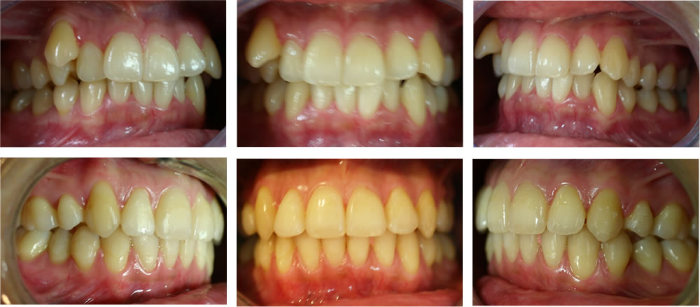叢生・八重歯の矯正治療例（20代女性 治療期間4年）