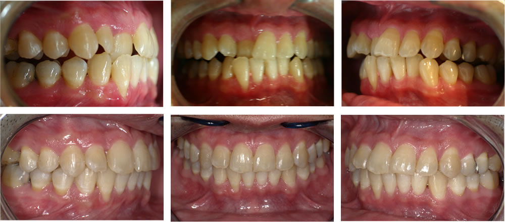 叢生・八重歯の矯正治療例の治療例