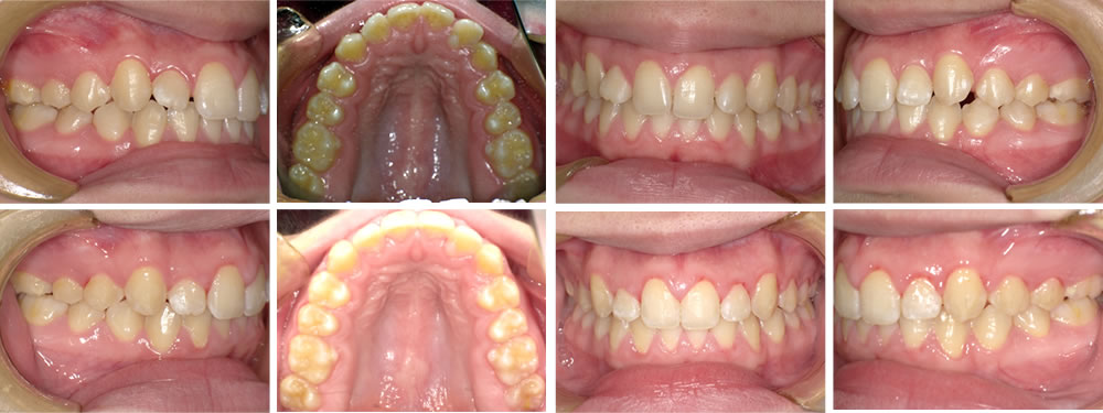 叢生・八重歯の矯正治療例（16歳女性 治療期間10か月）