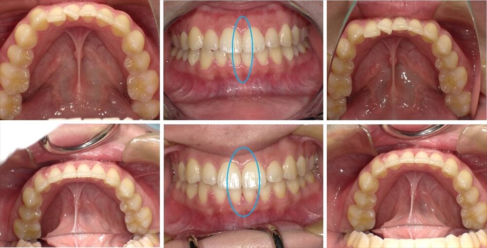 前歯の部分矯正治療例（20代女性 治療期間9ヶ月）