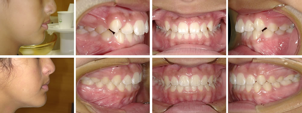 前歯の叢生・上顎前突(軽度)の治療例