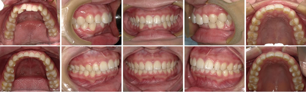 前歯の叢生・上顎前突(軽度)の治療例