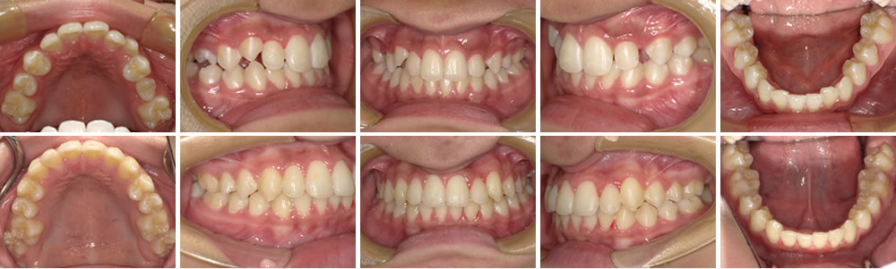 叢生・八重歯の治療例
