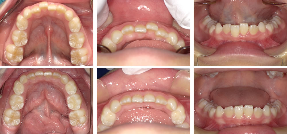 子どもの叢生・八重歯の矯正治療例