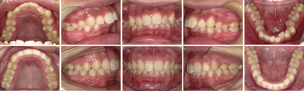 叢生・八重歯の治療例