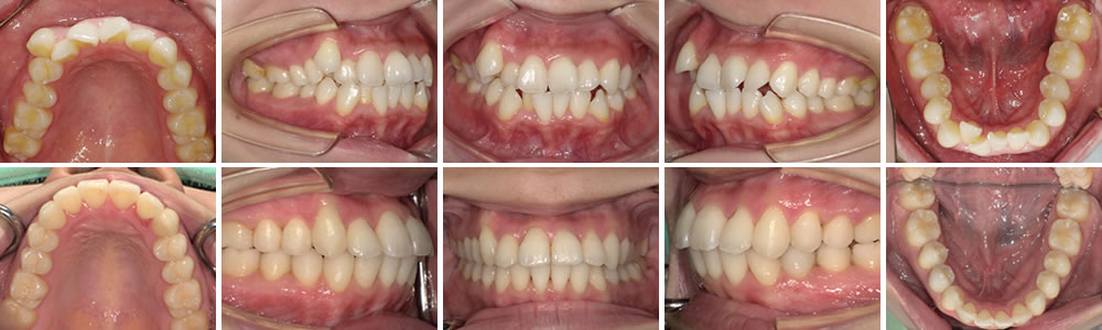 叢生の矯正治療例