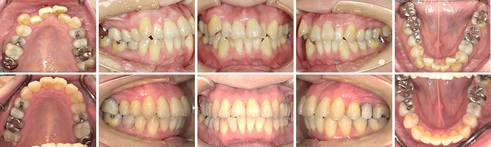 叢生・八重歯の治療例