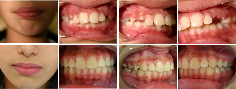 子どもの出っ歯の矯正治療例（10歳女子 治療期間3年）