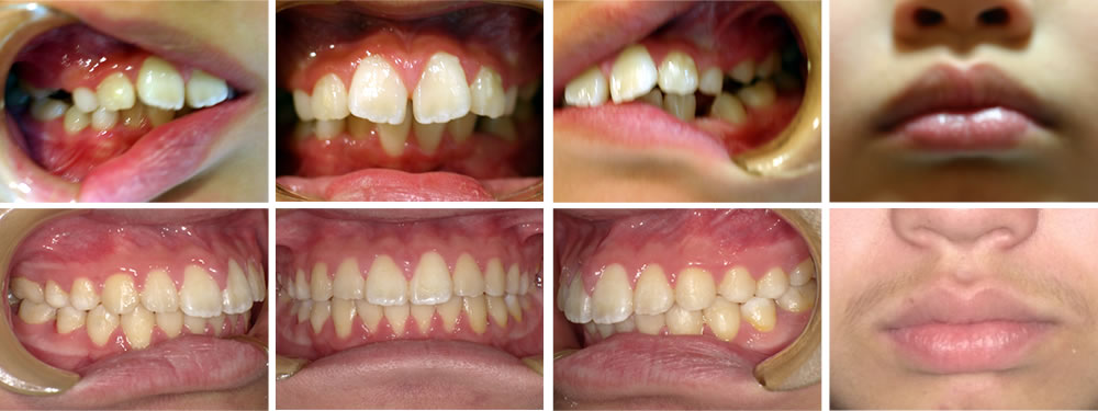 子どもの出っ歯の矯正治療例（10歳男子 治療期間4年）