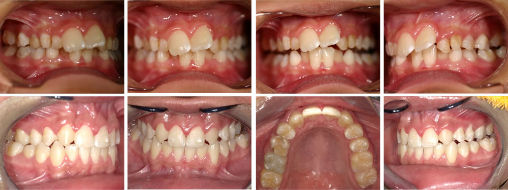 子どもの出っ歯の矯正治療例（8歳男子 治療期間6年）