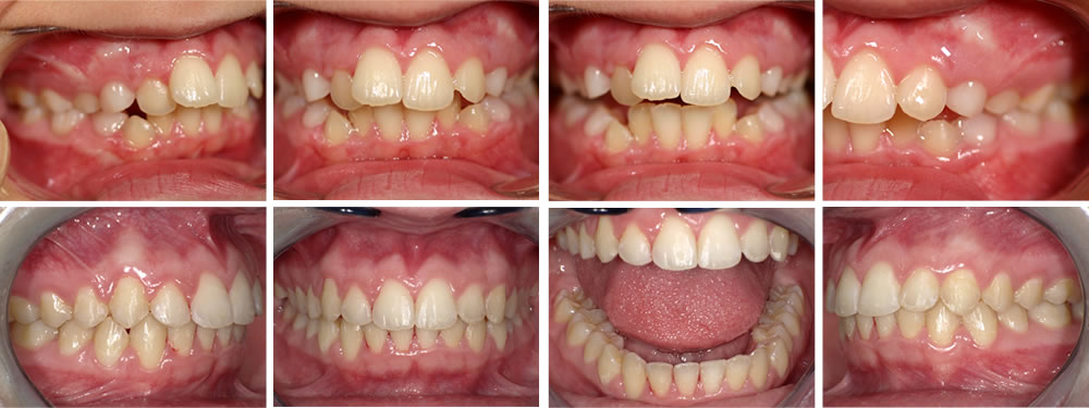 子どもの出っ歯の矯正治療例(11歳女子 治療期間5年)