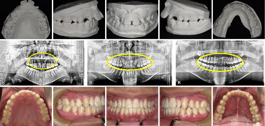 子どもの出っ歯の矯正治療例(14歳男子 治療期間4年)