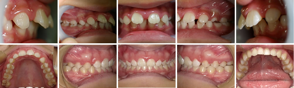子どもの出っ歯（上顎前突）の矯正治療例の治療例
